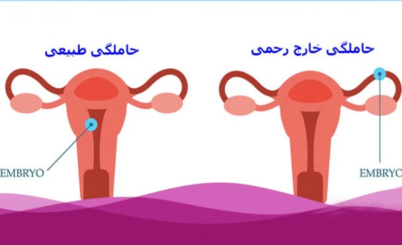 حاملگی خارج رحمی؛ چرا رخ می‌دهد و چه علائمی دارد؟