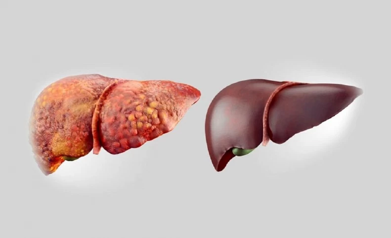 معجزه درمان کبد چرب با مصرف این مواد خوراکی